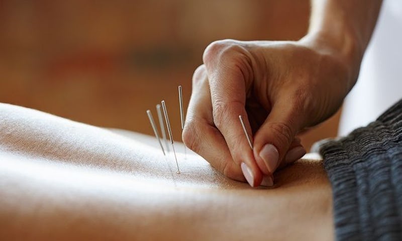 9 Best Acupuncturists in Chicago